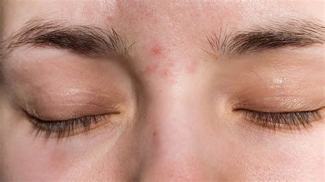 What Causes Acne Between Your Eyebrows